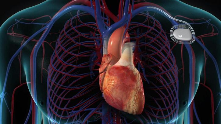 Cardiac Pacemaker 